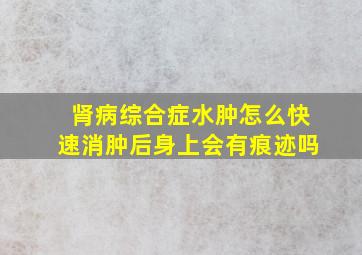 肾病综合症水肿怎么快速消肿后身上会有痕迹吗