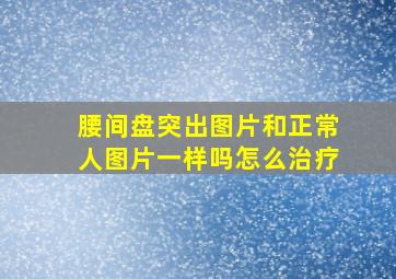 腰间盘突出图片和正常人图片一样吗怎么治疗