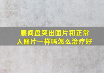 腰间盘突出图片和正常人图片一样吗怎么治疗好